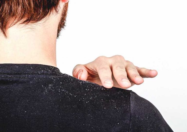 چگونه شوره سر را با روش های طبیعی درمان کنیم؟ چگونه شوره سر را با روش های طبیعی درمان کنیم؟