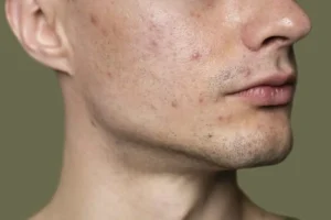 سیاه شدن لب‌