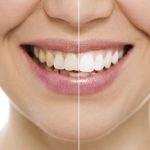 11 روش سفید کردن دندان در خانه