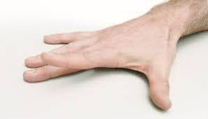 7 تمرین برای کاهش درد آرتروز دست
