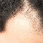 ریزش موی سکه ای: علائم، درمان و علل