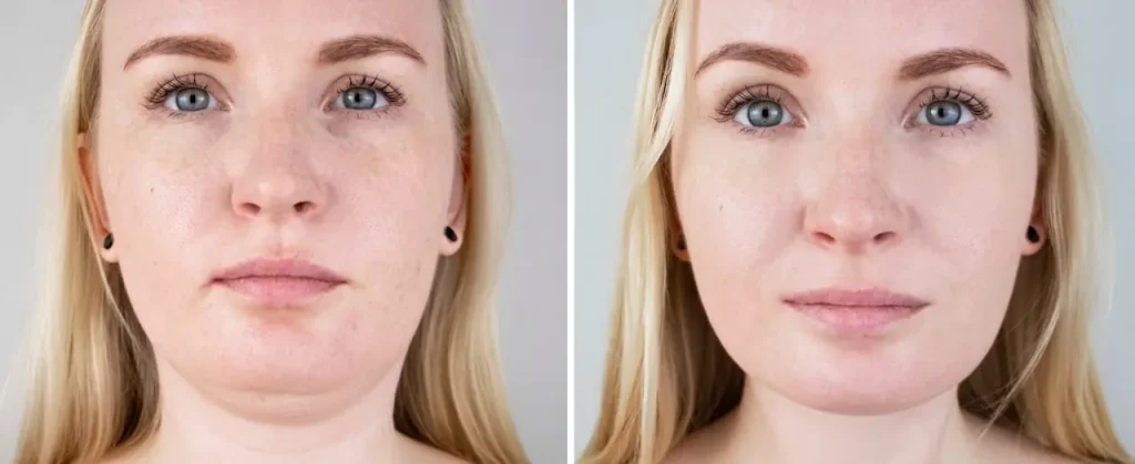 لاغری صورت؛ چگونه صورتمان را لاغر کنیم؟