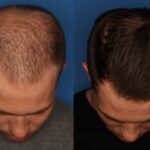 ماینوکسیدیل؛ همه‌چیز درباره رایج‌ترین درمان ریزش مو