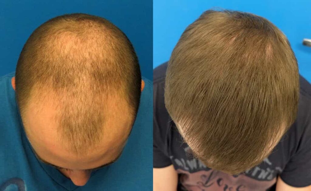 قبل و بعد استفاده از ماینوکسیدیل