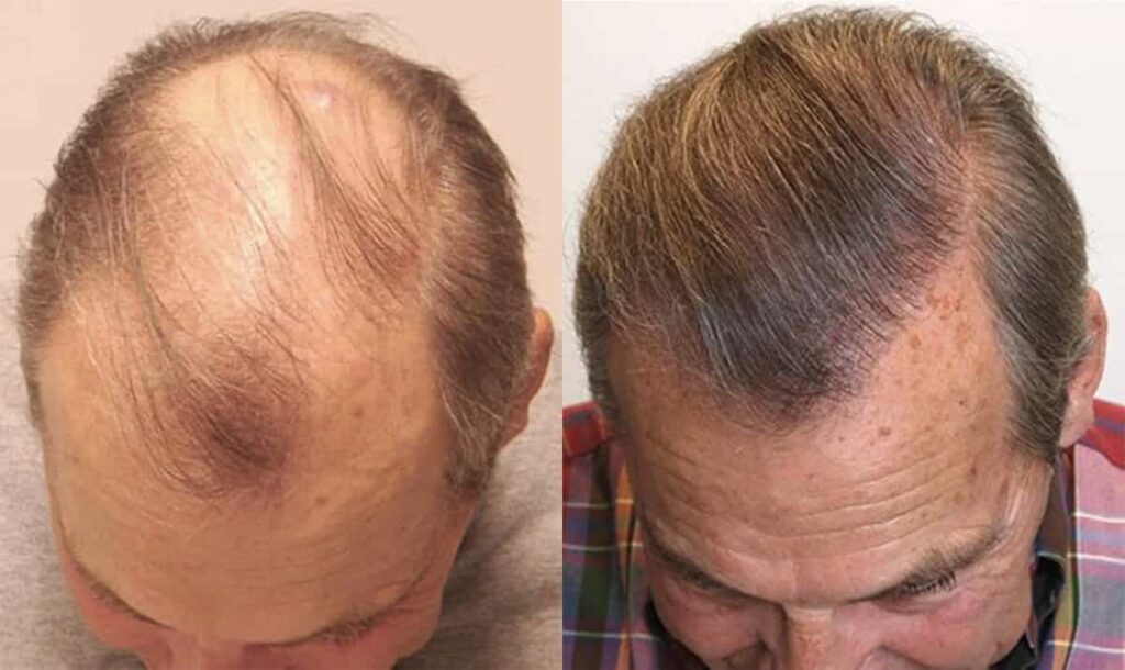 قبل و بعد استفاده از ماینوکسیدیل