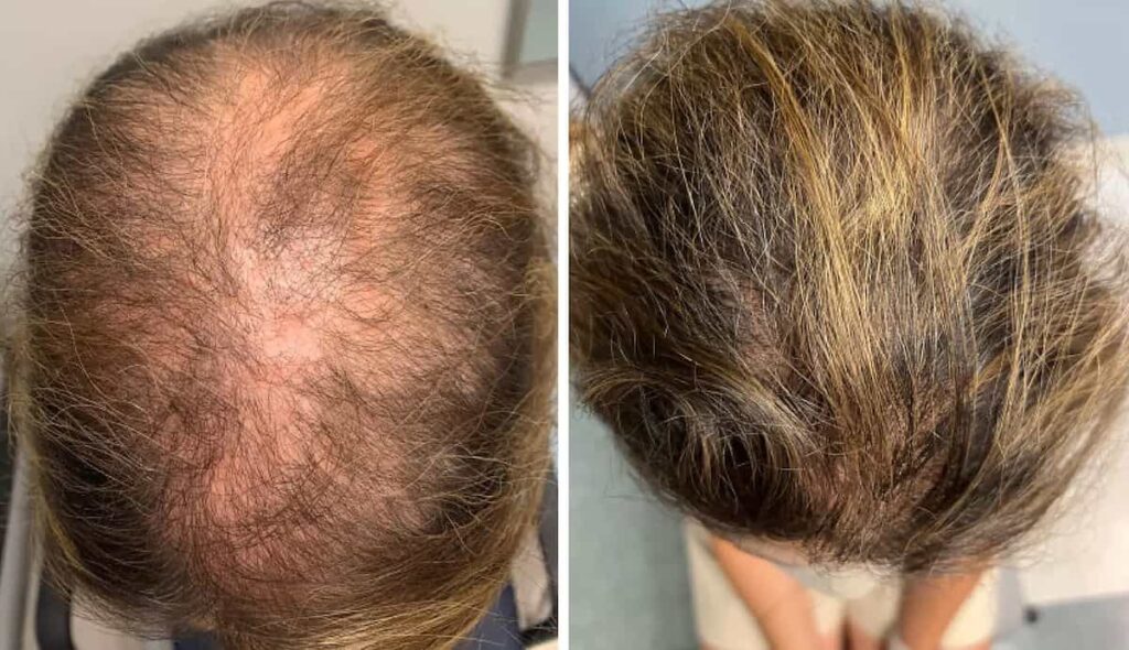 قبل و بعد استفاده از ماینوکسیدیل