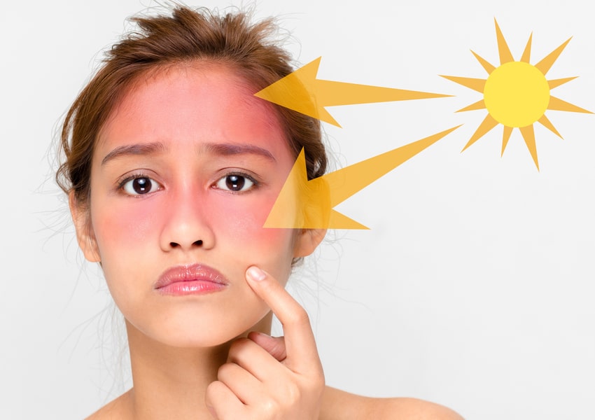 درمان آفتاب سوختگی در خانه با روش های ساده و طبیعی