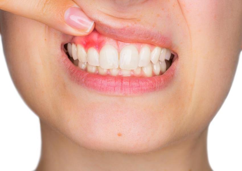 درمان خانگی عفونت دندان یا آبسه دندان با ۱۰ روش واقعا موثر