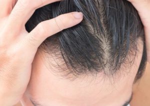 درمان ریزش مو با پانزده ماسک طبیعی و موثر