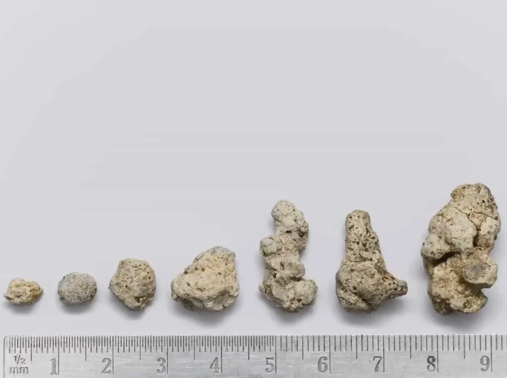 انواع سنگ کلیه