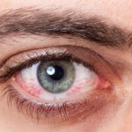 روش های درمان حساسیت چشم و پیشگیری از آن