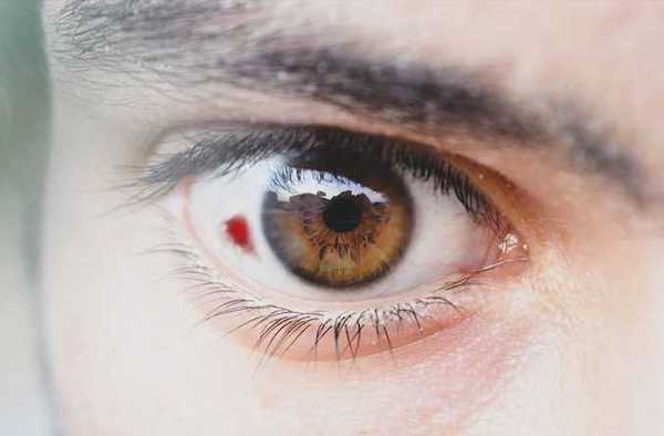 خونریزی چشم چیست و چه نکاتی باید درباره آن بدانیم