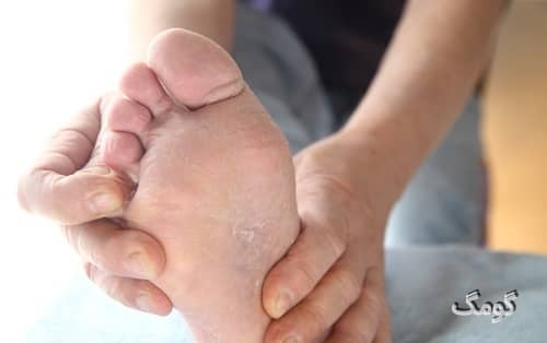 بیماری پای ورزشکار چیست؟ علائم، دلایل، درمان و پیشگیری