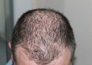 ریزش مو به دلیل کمبود ویتامین D و علائم و درمان آن