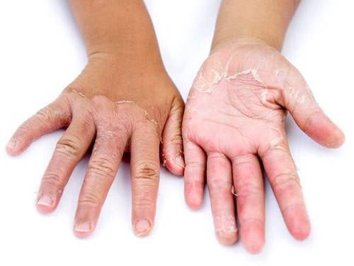پوسته پوسته شدن پوست چرا اتفاق می افتد و چگونه درمان می شود؟