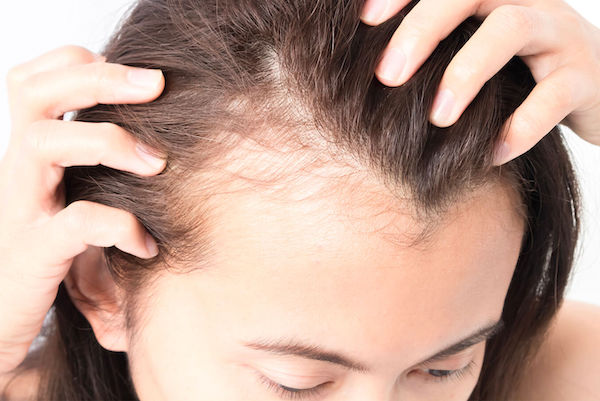 ریزش مو در زنان: ۱۱ علت شایع ریزش مو در زنان