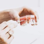 ایمپلنت دندان ؛ نحوه انجام، مزایا و خطرات کاشت دندان