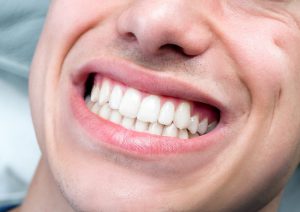 دندان قروچه یا بروکسیسم چیست؟ از علائم تا درمان