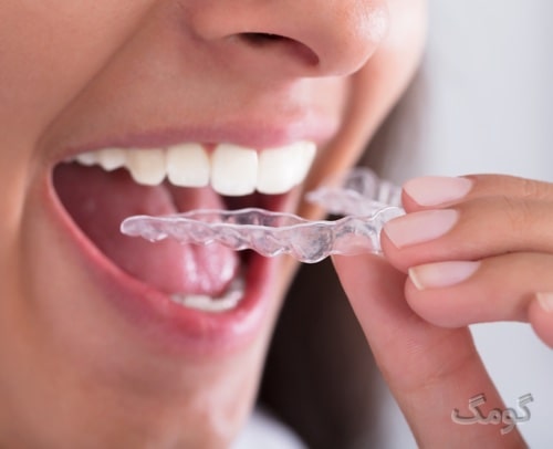 دندان قروچه یا بروکسیسم چیست؟ از علائم تا درمان