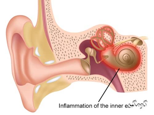 آماس گوش درونی یا لابیرنتیت؛ علائم، دلایل، تشخیص و درمان
