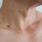 منگوله پوستی روی گردن چیست؟ علائم، دلایل و درمان آن