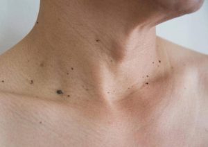 منگوله پوستی روی گردن چیست؟ علائم، دلایل و درمان آن