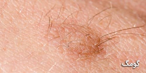 حذف منگوله های پوستی با لاک ناخن؛ راهنمایی و خطرات احتمالی