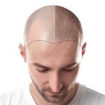 ضربه به سر بعد از کاشت مو باعث ریزش مو میشود؟