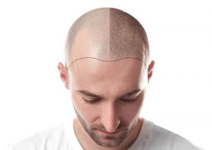 ضربه به سر بعد از کاشت مو باعث ریزش مو میشود؟