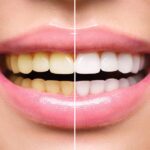 آیا سفید کردن دندان بی خطر است؟