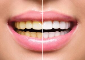 آیا سفید کردن دندان بی خطر است؟
