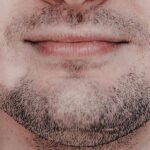 درمان کچلی ریش مردان(قارچ صورت) چیست؟