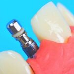 در مورد قالب گیری ایمپلنت دندان چه می دانید؟