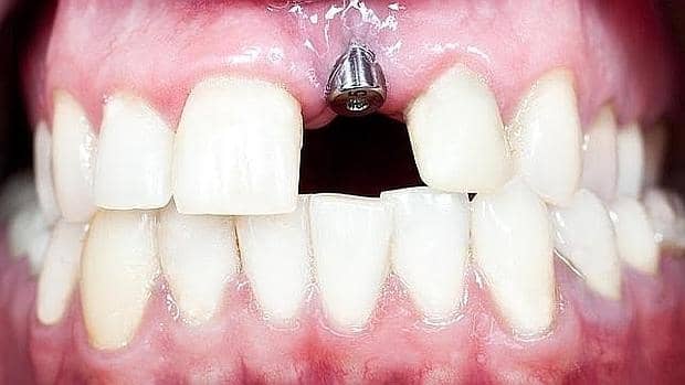 در مورد قالب گیری ایمپلنت دندان چه می دانید؟