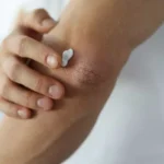 بهترین روش های رفع تیرگی آرنج و زانو