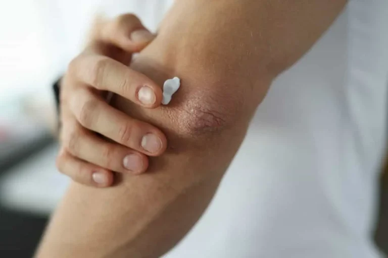 بهترین روش های رفع تیرگی آرنج و زانو