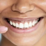 ایمپلنت دندان چیست و قیمت آن چگونه محاسبه می‌شود؟