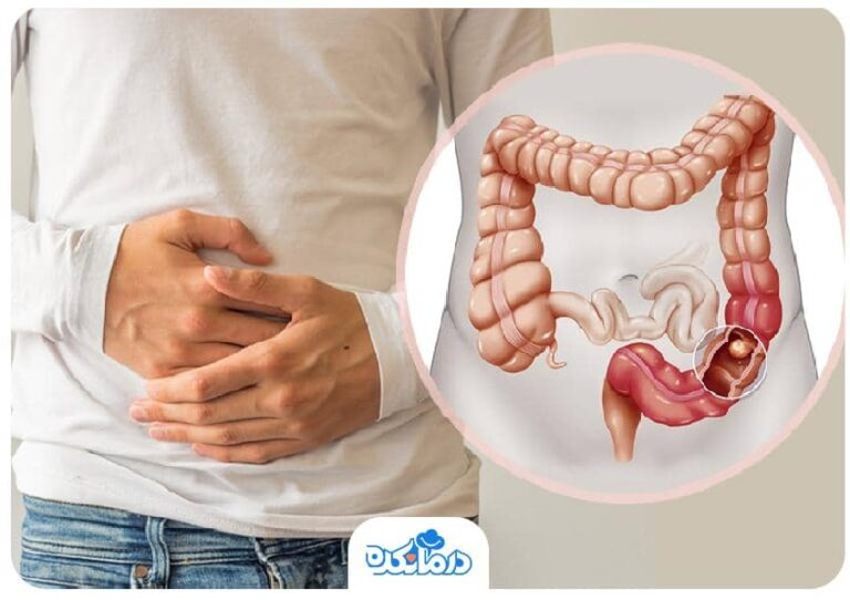 چطور با کرون یا کولیت روده زندگی کنیم؟ نکات زندگی در حین بیماری