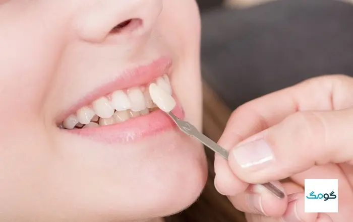 سفید کردن دندان با روکش دندان
