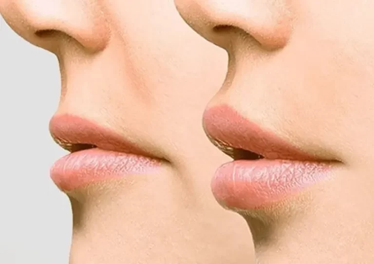 لیفت سانترال لب چیست؟