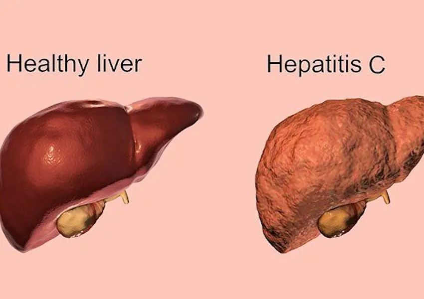 علائم هپاتیت C و درمان آن