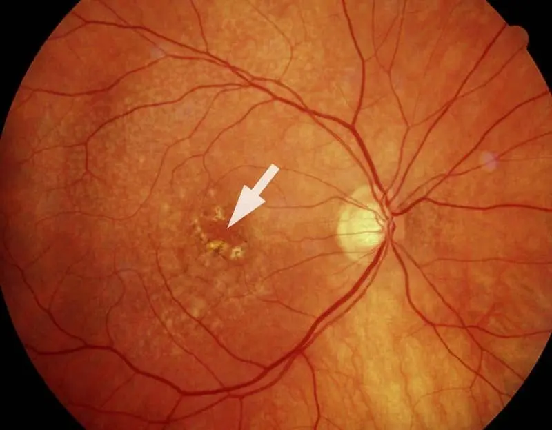 بیماری ماکولار ؛ از علت تا درمان و نکات کلیدی که باید بدانید