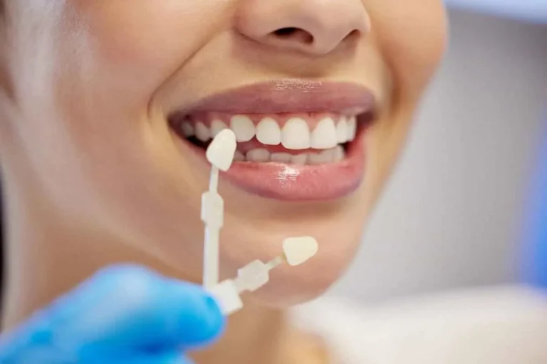 تفاوت لمینت و کامپوزیت؛ بهترین روش اصلاح طرح لبخند