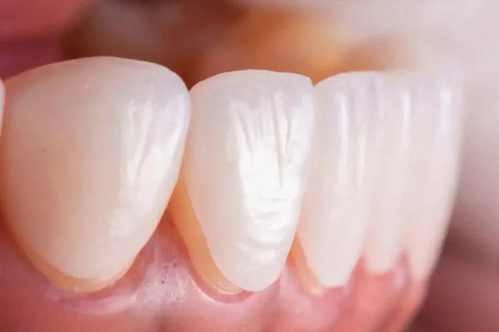 تفاوت لمینت و کامپوزیت؛ بهترین روش اصلاح طرح لبخند