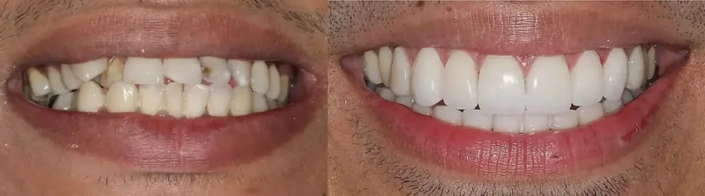 تفاوت لمینت و کامپوزیت؛ بهترین روش اصلاح طرح لبخند