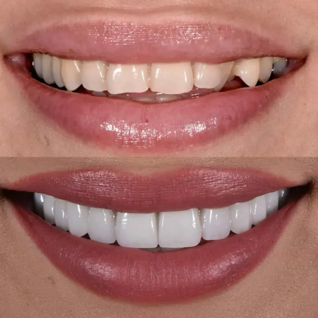 تفاوت لمینت و کامپوزیت؛ بهترین روش اصلاح طرح لبخند