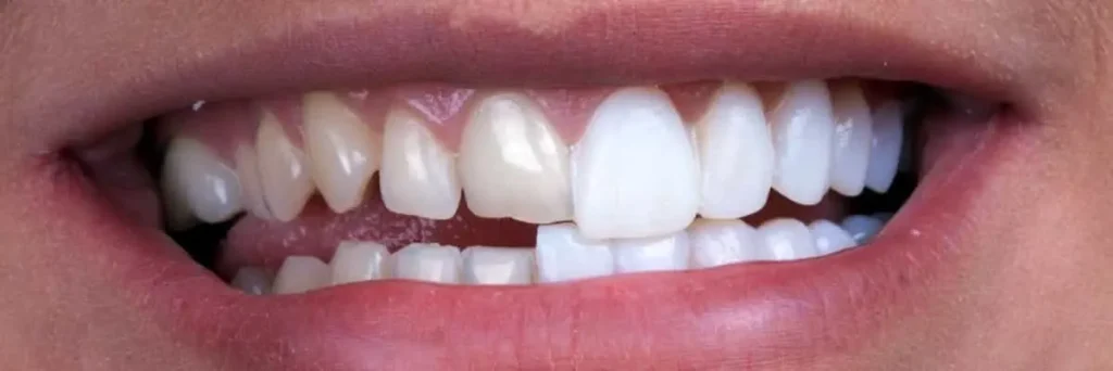 تفاوت لمینت و کامپوزیت؛ بهترین روش اصلاح طرح لبخند