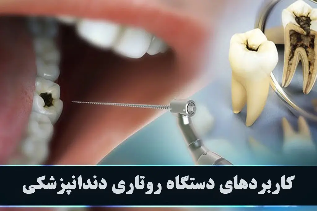 کاربرد دستگاه روتاری دندانپزشکی