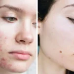 آیا کورتون برای جوش صورت درمان مناسبی است؟