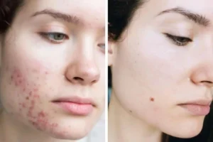 آیا کورتون برای جوش صورت درمان مناسبی است؟